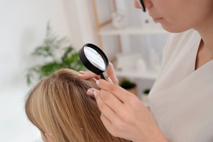 Flake-Free Scalp After Treatment